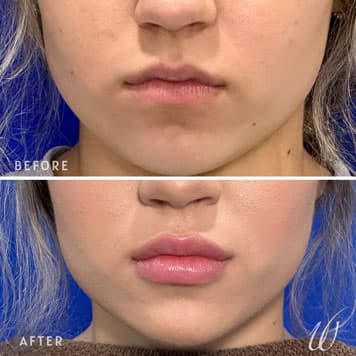 Comparison of a woman's lips before and after receiving Juvederm lip filler treatment at Weiler Plastic Surgery