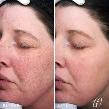 Comparison of a woman's face before and after receiving IPL, intense pulsed light, therapy treatment at Weiler Plastic Surgery