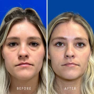 Comparison of a woman's lower eyelids before and after receiving a blepharoplasty procedure at Weiler Plastic Surgery