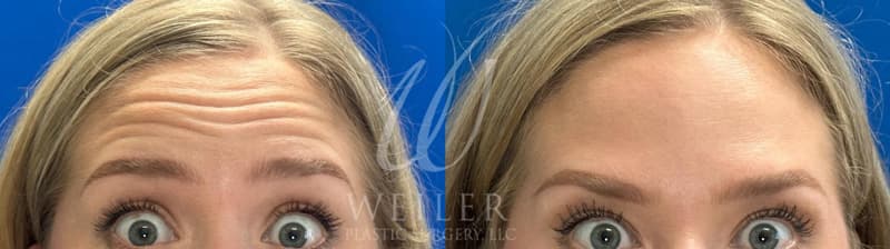 Before & After Fine Lines & Wrinkles