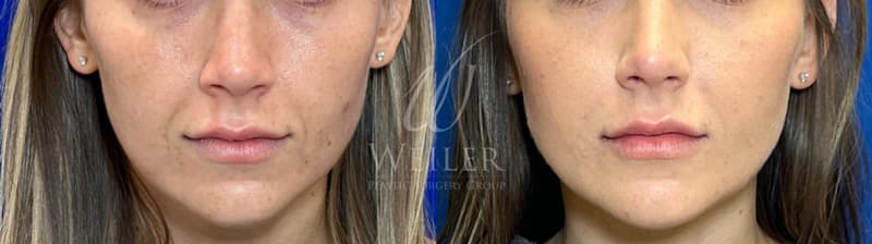 Before & After Nasolabial Folds