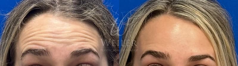 Before & After Frown Lines, Crow's Feet, and Forehead Wrinkles