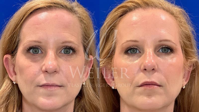 Before & After Flattening Cheeks