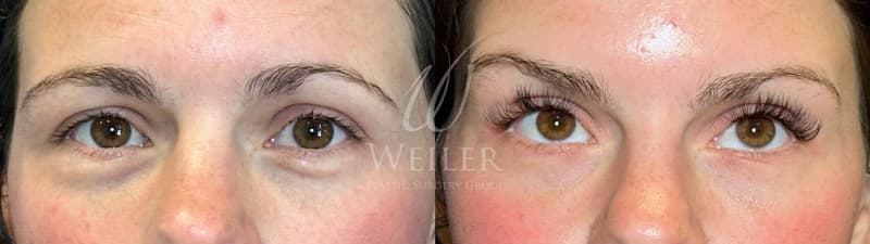 Before & After Under Eye Hollows