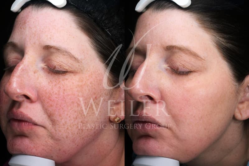 Before & After Sun Damage