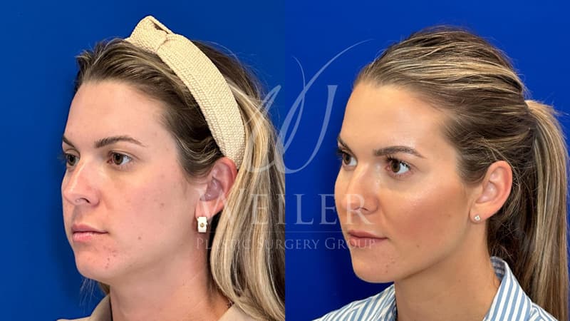 Before & After Weak Jawline