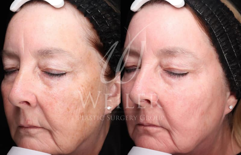 Before & After Hyperpigmentation/Melasma