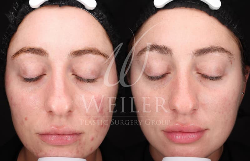 Before & After Acne