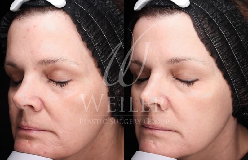 Before & After Enlarged Pores