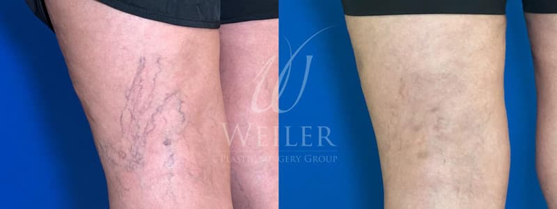 Before & After Veins