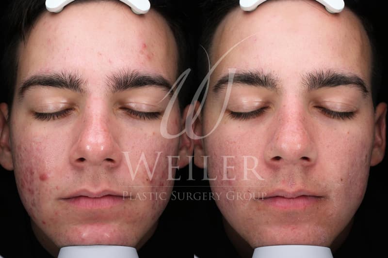 Before & After Acne Scars