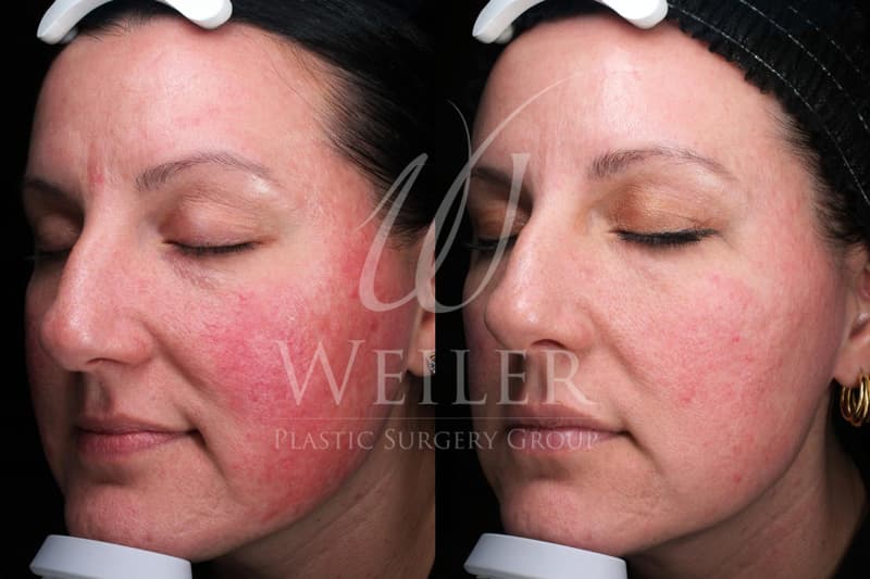 Before & After Redness