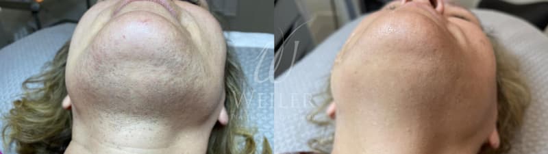 Before & After Unwanted Hair