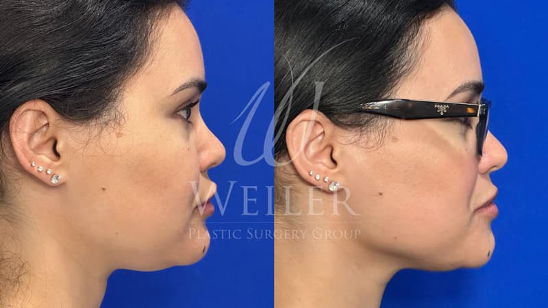 Before & After Double Chin