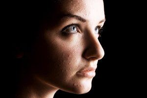 women-acne-300x200