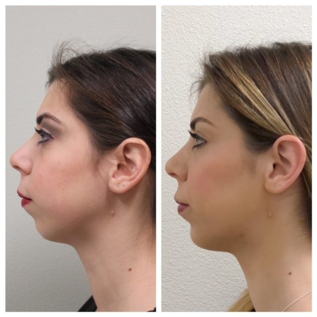 chin augmentation with juvederm