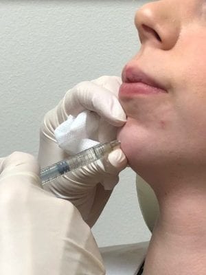 chin augmentation with juvederm