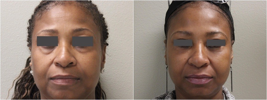 cosmetic filler baton rouge