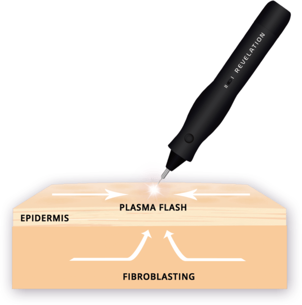 Plasma Pen Diagram