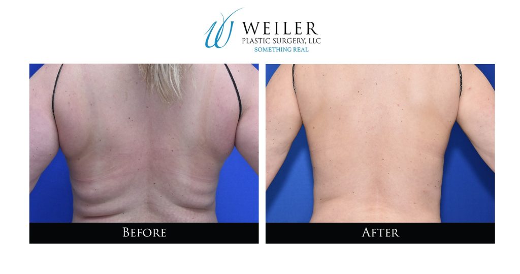 CoolSculpting Before and After