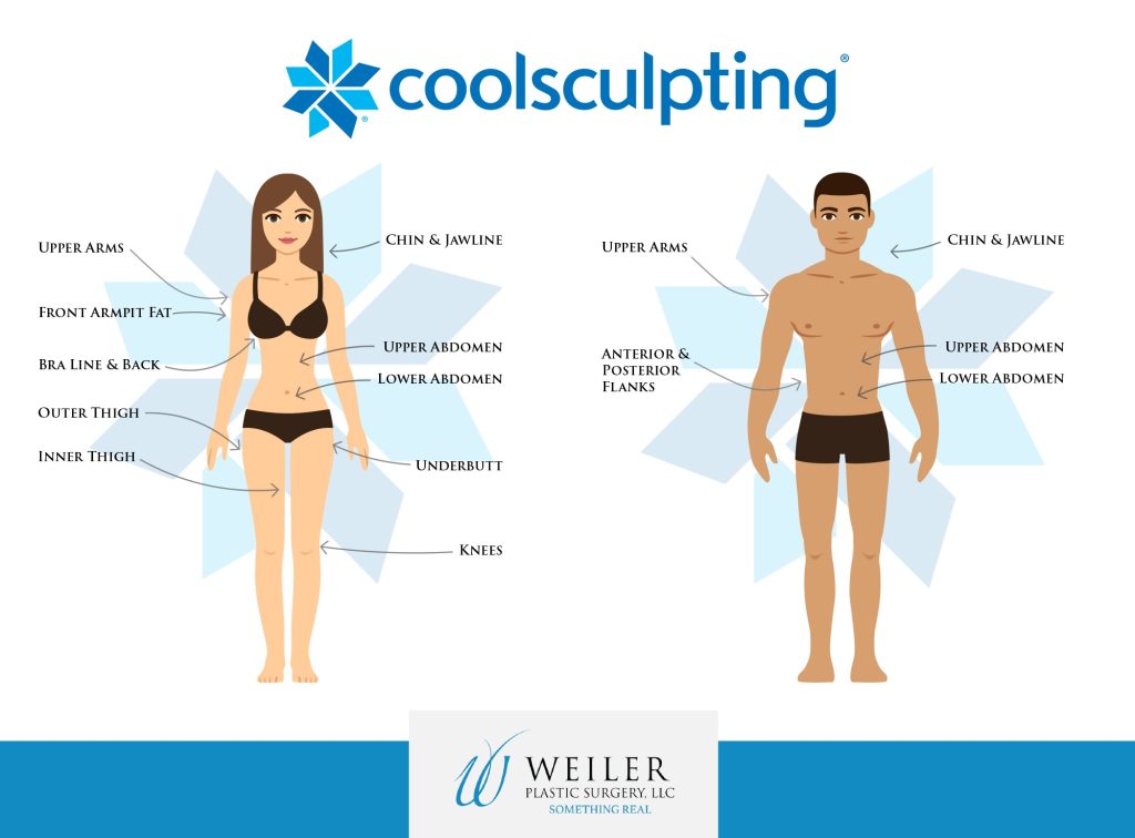 Infographic of CoolSculpting treatment areas on women and men.