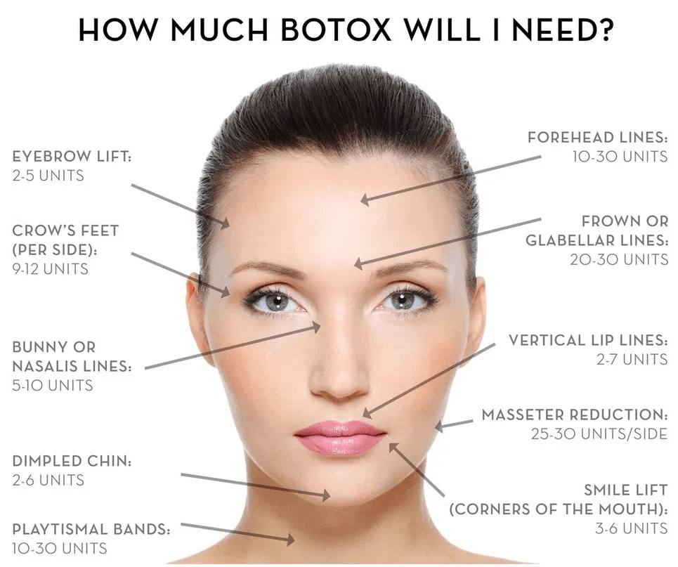 Diagram depicting units of Botox needed per area on face.
