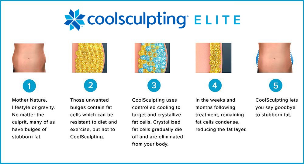 Coolsculpting Elite process