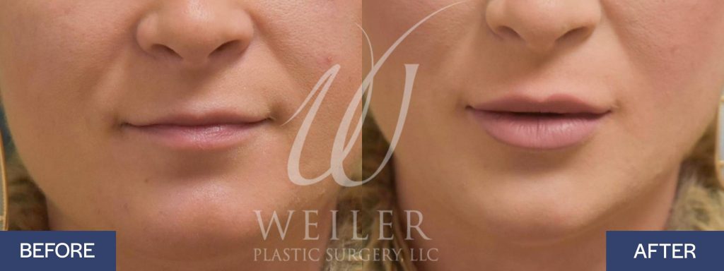 Lip filler before-and-after in Baton Rouge, LA