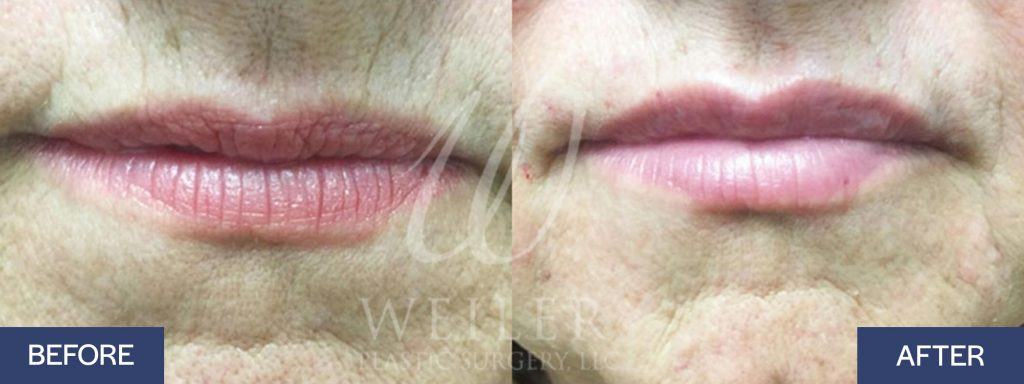 Lip filler before-and-after in Baton Rouge, LA