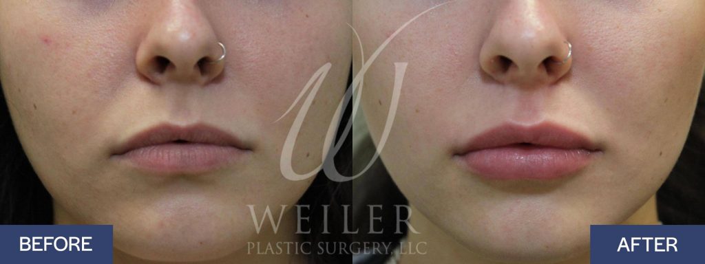 Lip filler before-and-after in Baton Rouge, LA