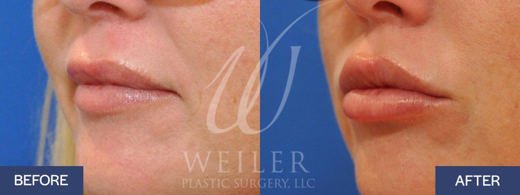 Lip filler before-and-after in Baton Rouge, LA