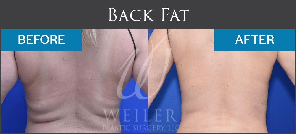 CoolSculpting Before-and-After