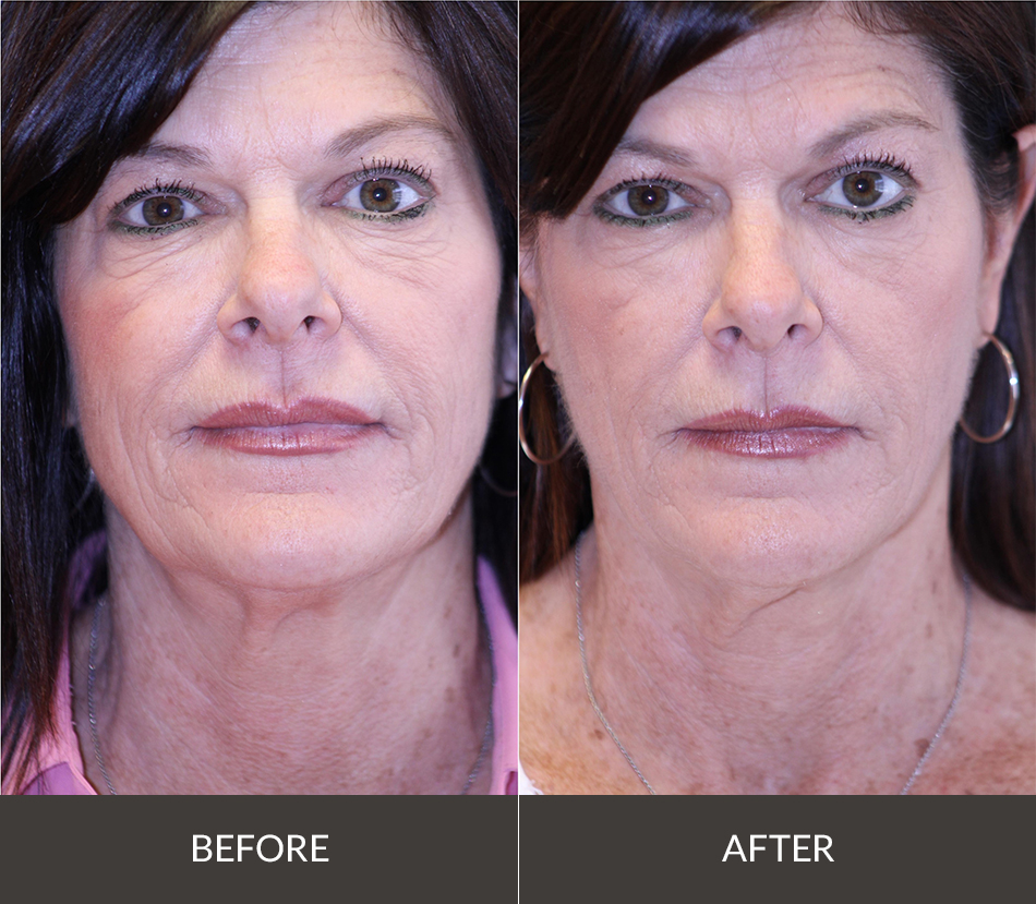 Sofwave Skin Tightening in Baton Rouge Weiler Plastic Surgery