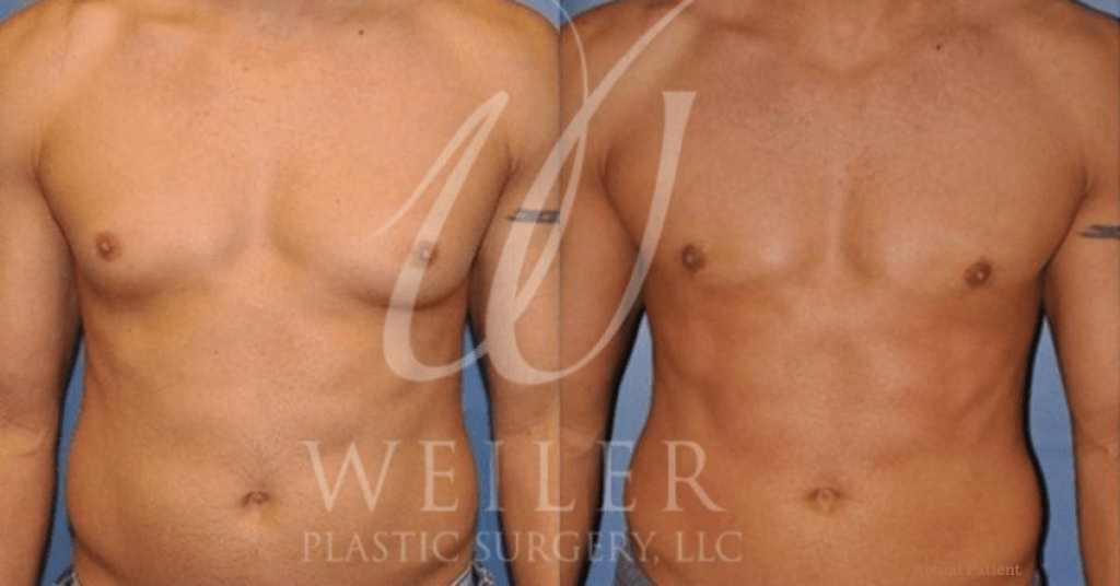 Before and after image of a male breast reduction procedure performed by Weiler Plastic Surgery on an actual patient