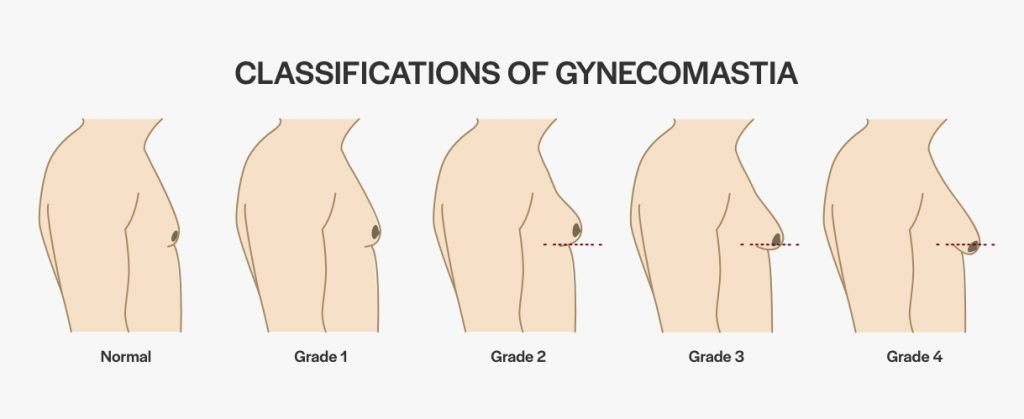 Gynecomastia classifications, from non-gynecomastia to Grade 4.