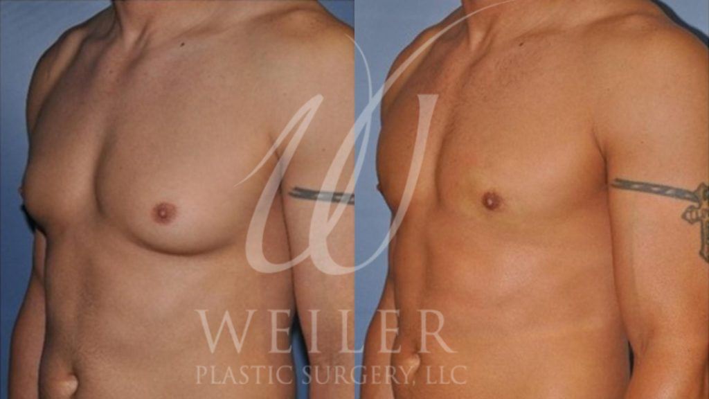 Partial profile view of man before and after gynecomastia surgery.