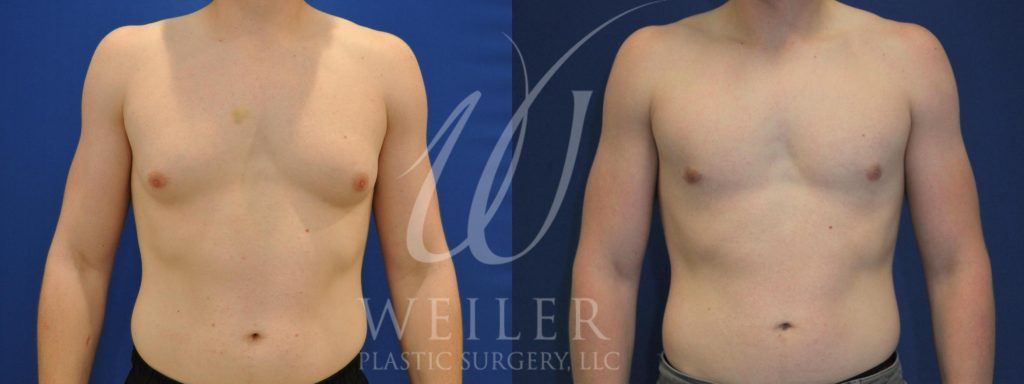 Front view of male patient's torso before and after male breast reduction.