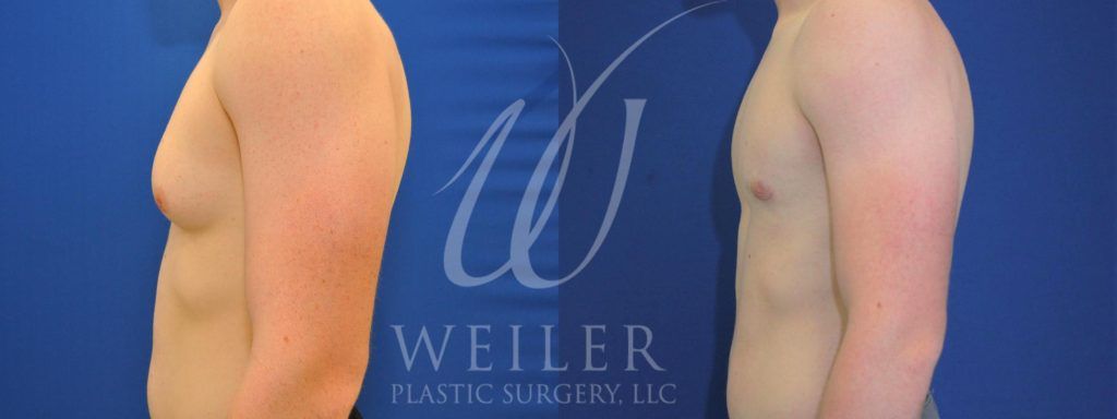 Profile a male patient's torso before and after male breast reduction.