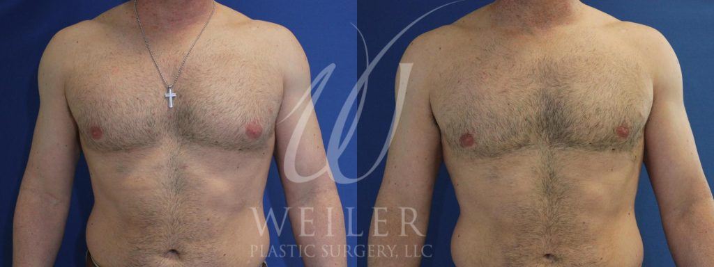 Front view of man's chest before and after male breast reduction surgery.