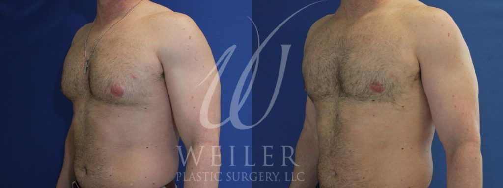 Left oblique view of man's chest before and after male breast reduction surgery.