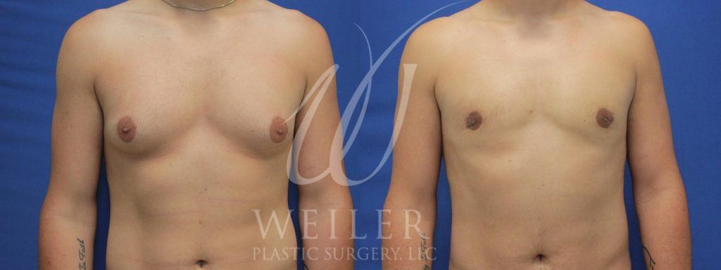 Man's torso in front view showing enlarged breasts before and reduced breasts after gynecomastia surgery.