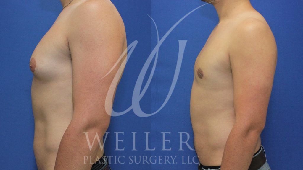 Man's torso profile showing enlarged breasts before and reduced breasts after gynecomastia surgery.
