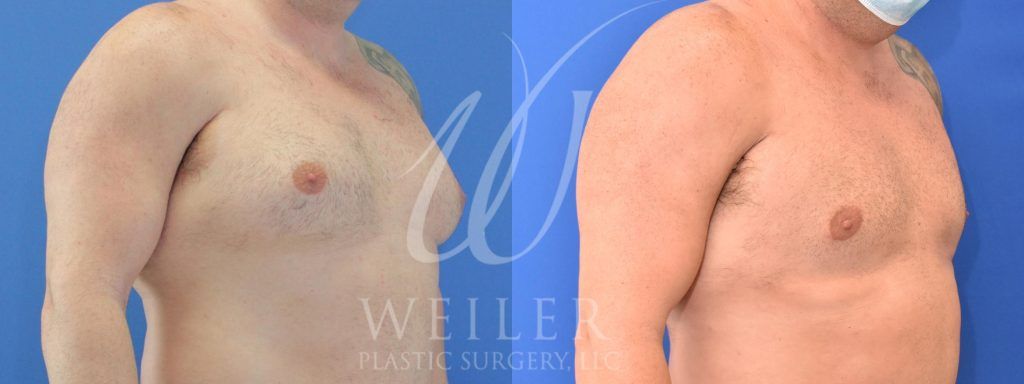 Right oblique view of patient's chest before and after breast reduction.