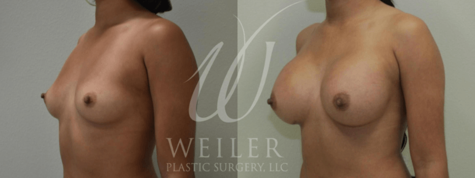 Breast augmentation before & after