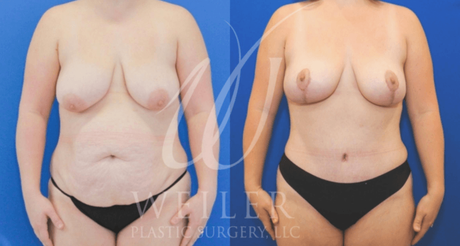 Breast lift before & after
