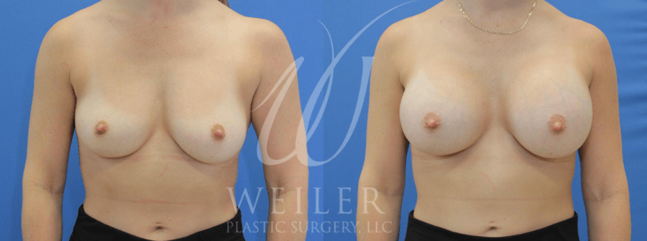 Breast augmentation before & after