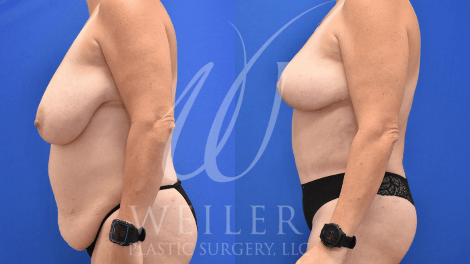 Breast lift before & after