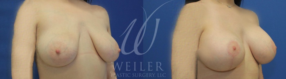 Breast lift with augmentation before & after