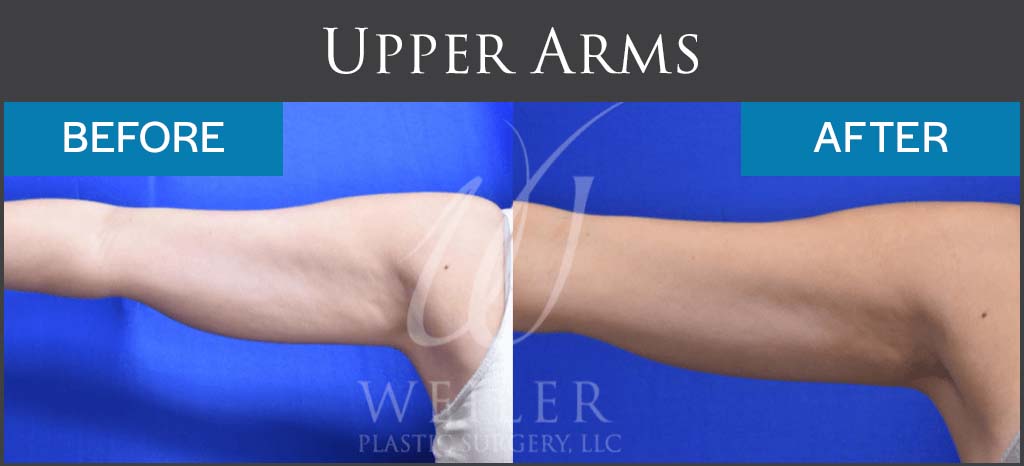 Coolsculpting before and after
