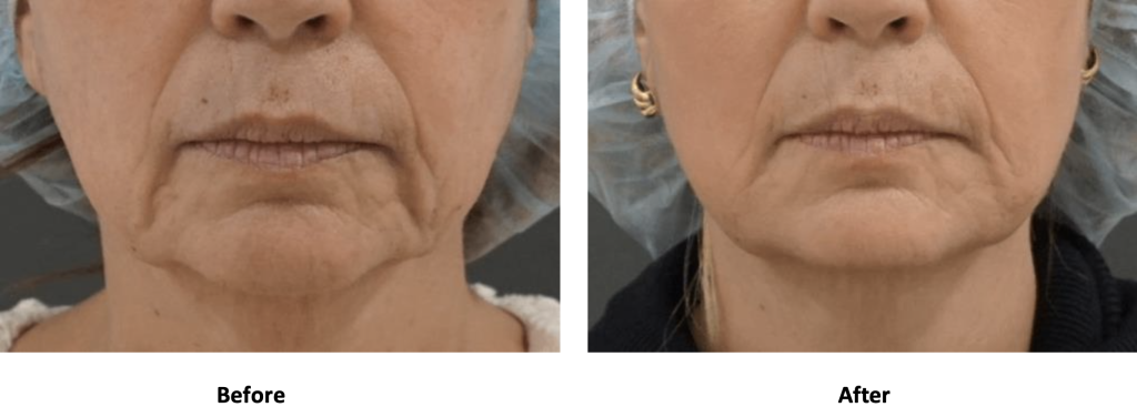 Woman before and after sofwave treatment